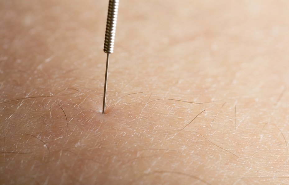 acupuntura